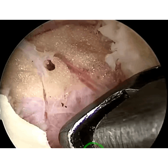 UBE-UBE-Keyhole Anatomical Layers (High Definition) AYDEFY